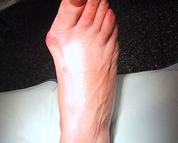 bunion